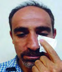 آلودگی چشمی