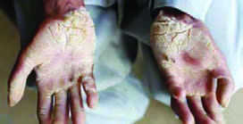 اثر آلودگی آب و خاک بر پوست