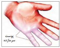 عوارض ناشی از سرما